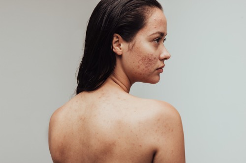 Descobreix les causes i remeis per l'acne – Adeslas Salud y Bienestar