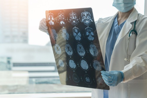 Descobreix què és i com prevenir el dany cerebral adquirit – Adeslas Salud y Bienestar